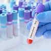 Eliminating undernutrition could prevent up to 2.3 Mn TB cases globally: Study