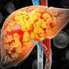 One in Three Urban Indians May Have Fatty Liver, Risk Begins at 30