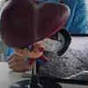 Fatty liver disease may reduce body’s ability to use Vitamin D: PGI study
