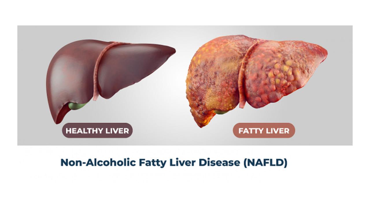 Fatty Liver: పైకి లక్షణాలేమీ కనిపించని సైలెంట్‌ కిల్లర్‌.. నిర్లక్ష్యం చేస్తే మీ ఒంట్లో ఈ పార్ట్‌లన్నీ మటాష్‌!