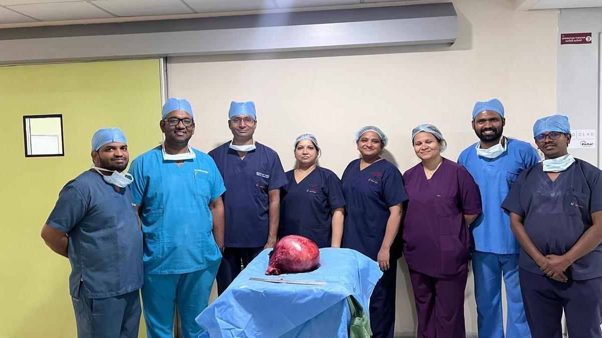 Hyderabad doctors save woman with rare giant uterine fibroid complication