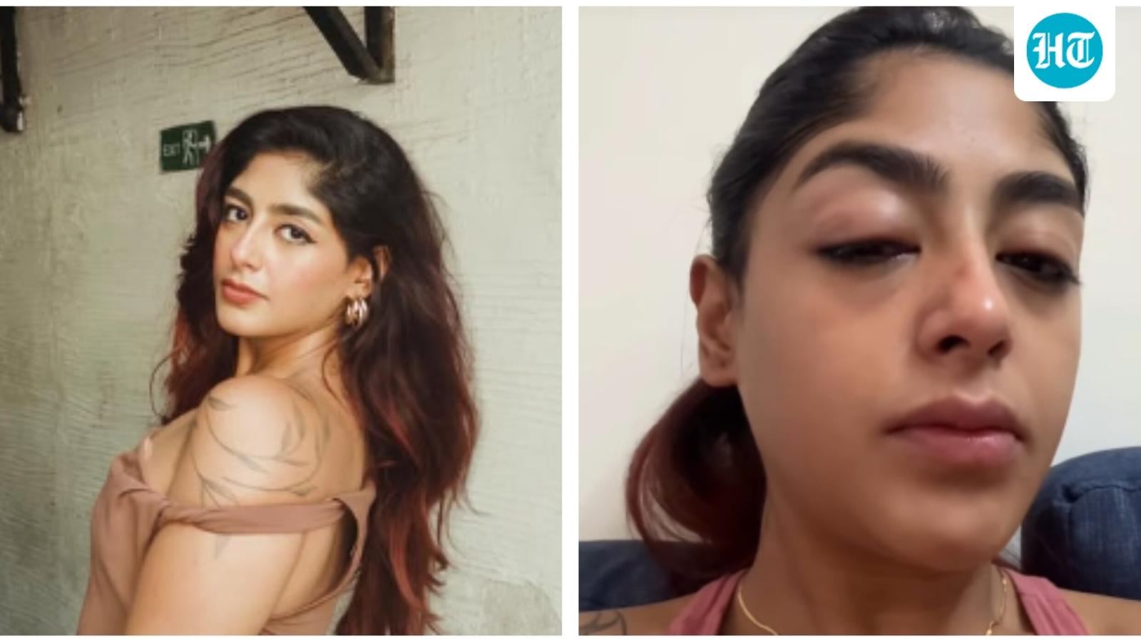 ‘Tooth broke, face swelled up’: Splitsvilla 16 contestant Preet Singh alleges physical assault by a man in a Mumbai club