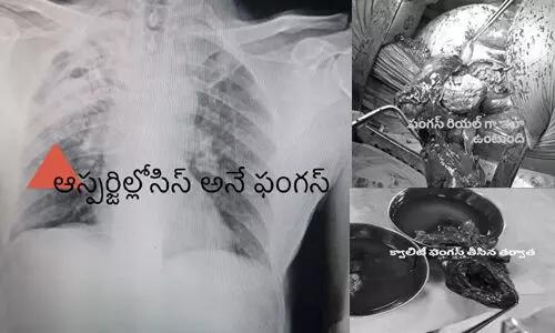 ఊపిరితిత్తులులో ఫంగస్ కు ఆపరేషన్